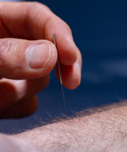acupuncture needle being placed in patient